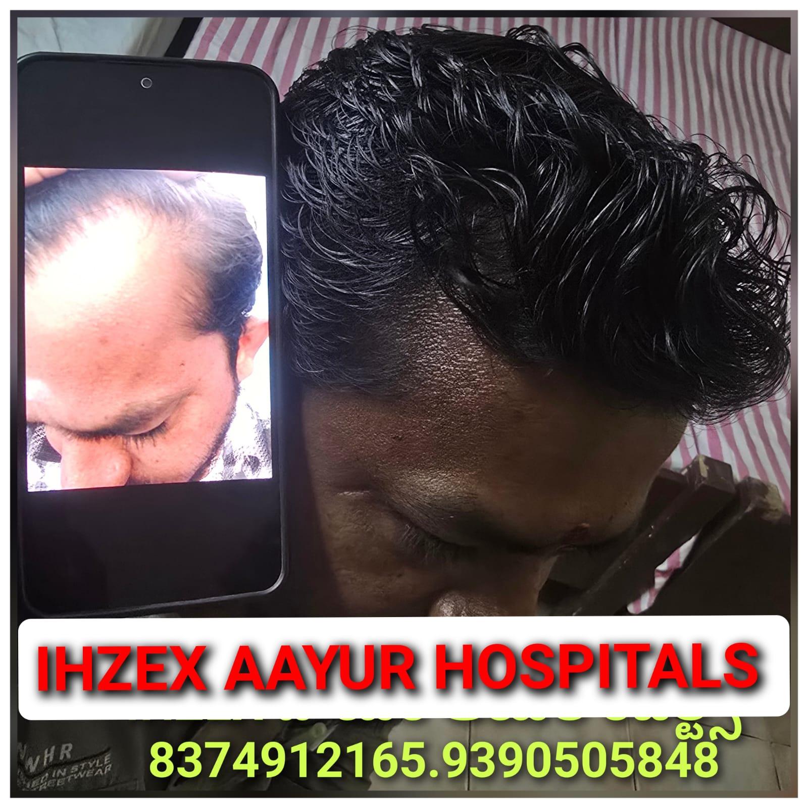 Hair Recovery Result 2