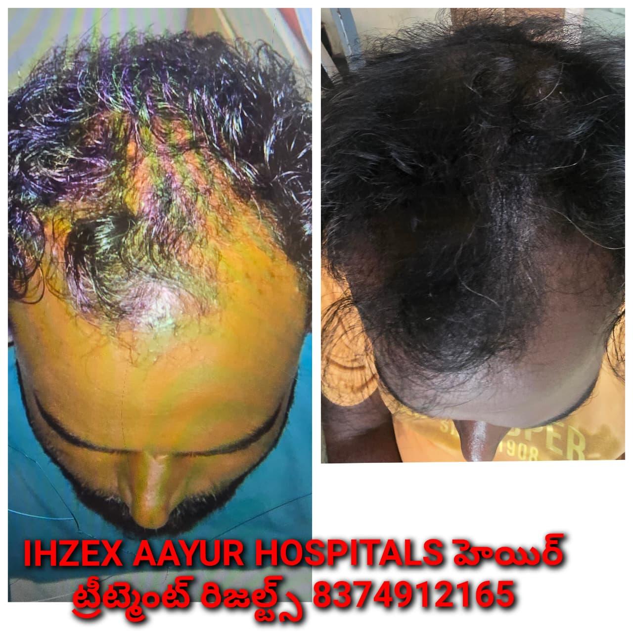 Hair Recovery Result 4